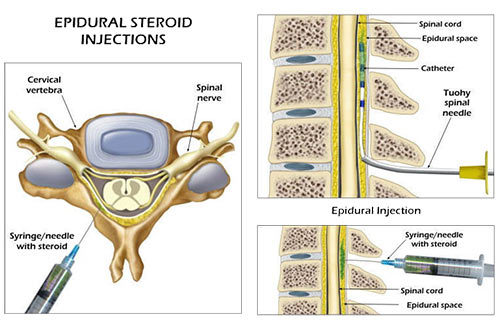 Lumbar Epidural Steroid Injection